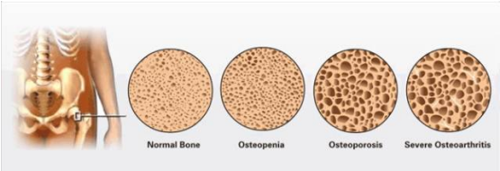 一種“靜悄悄”的疾病——骨質疏松
