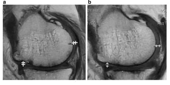 關節內注射干細胞治療骨關節炎5例臨床研究